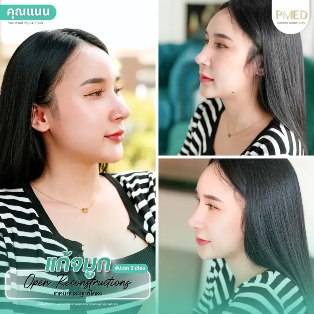 rib-cartilage-000005