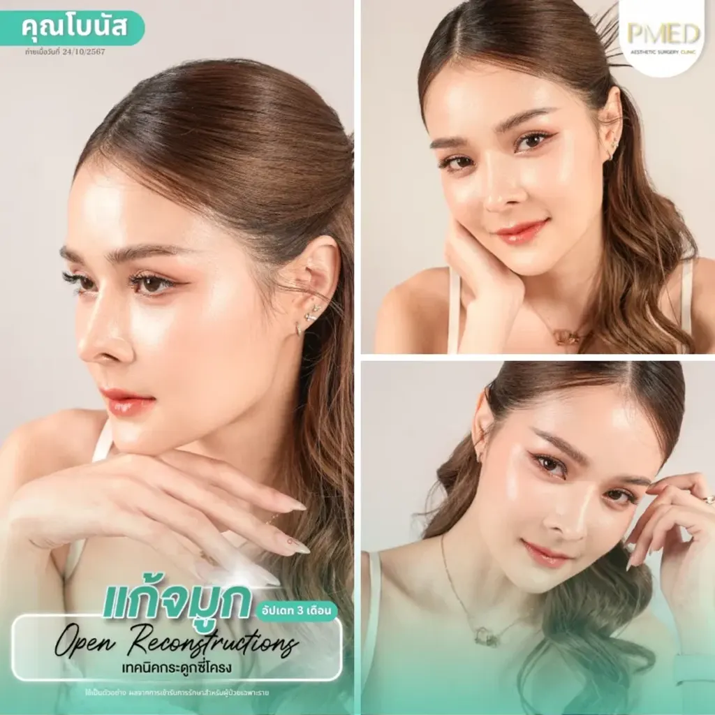 rib-cartilage-000016