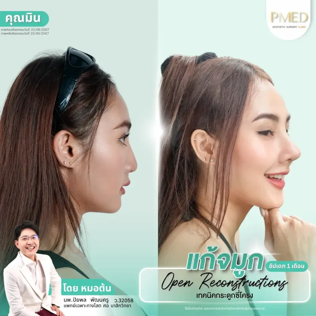 rib-cartilage-000018