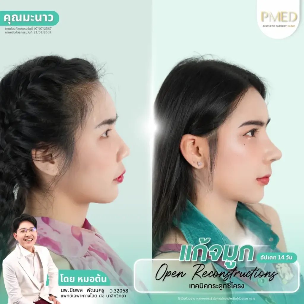 rib-cartilage-000019
