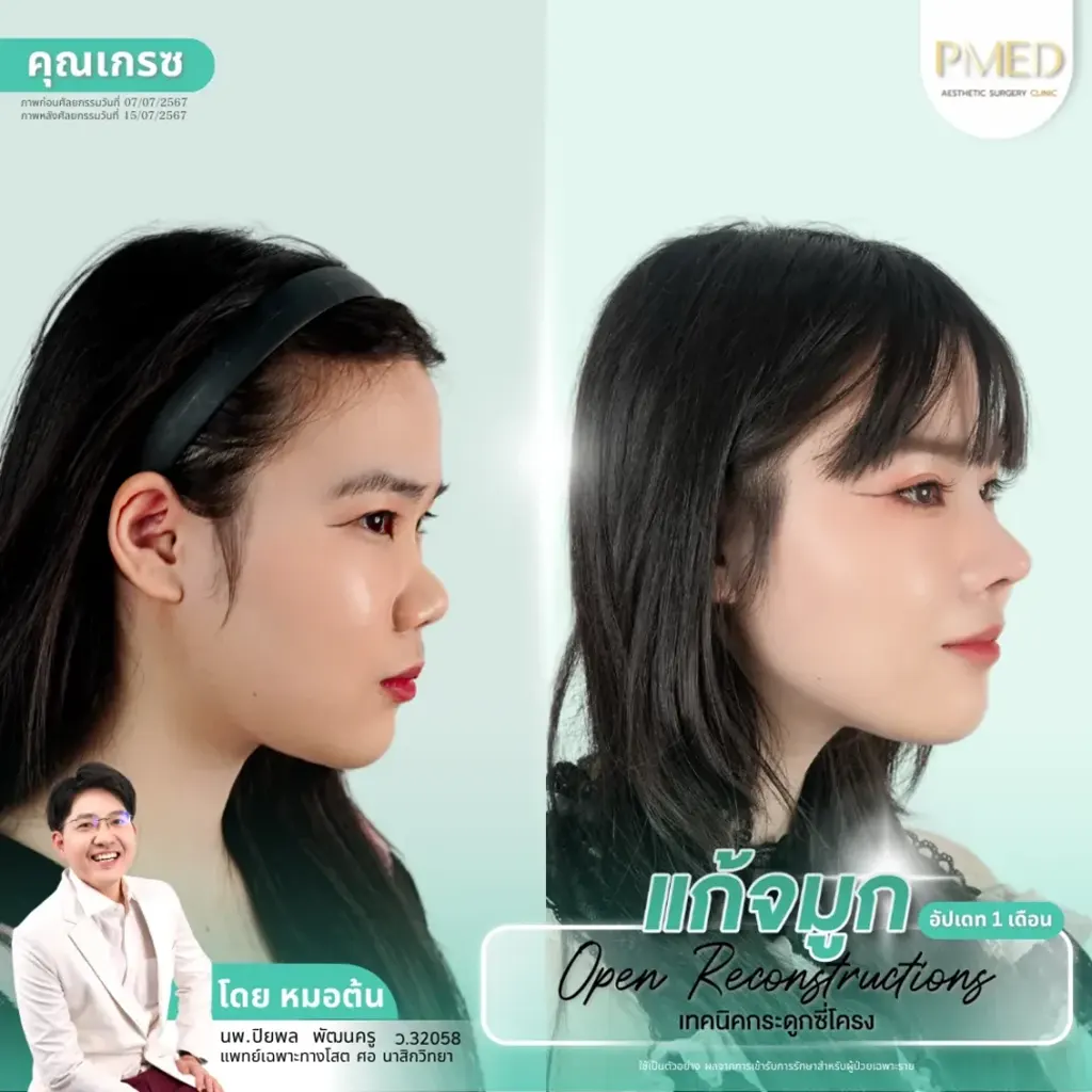 rib-cartilage-000020