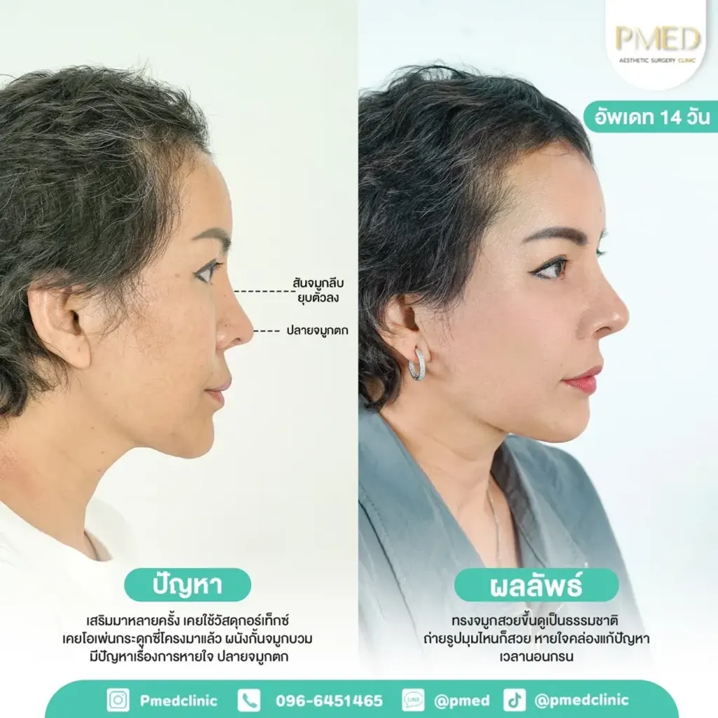 rib-cartilage-000021