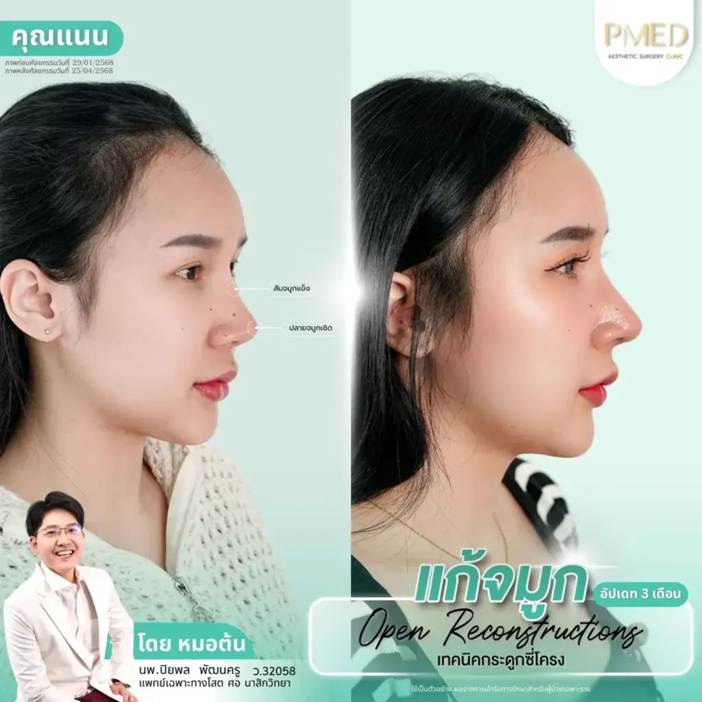 rib-cartilage-000022