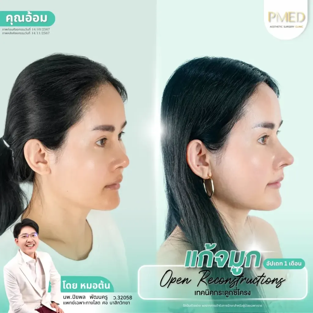 rib-cartilage-000023