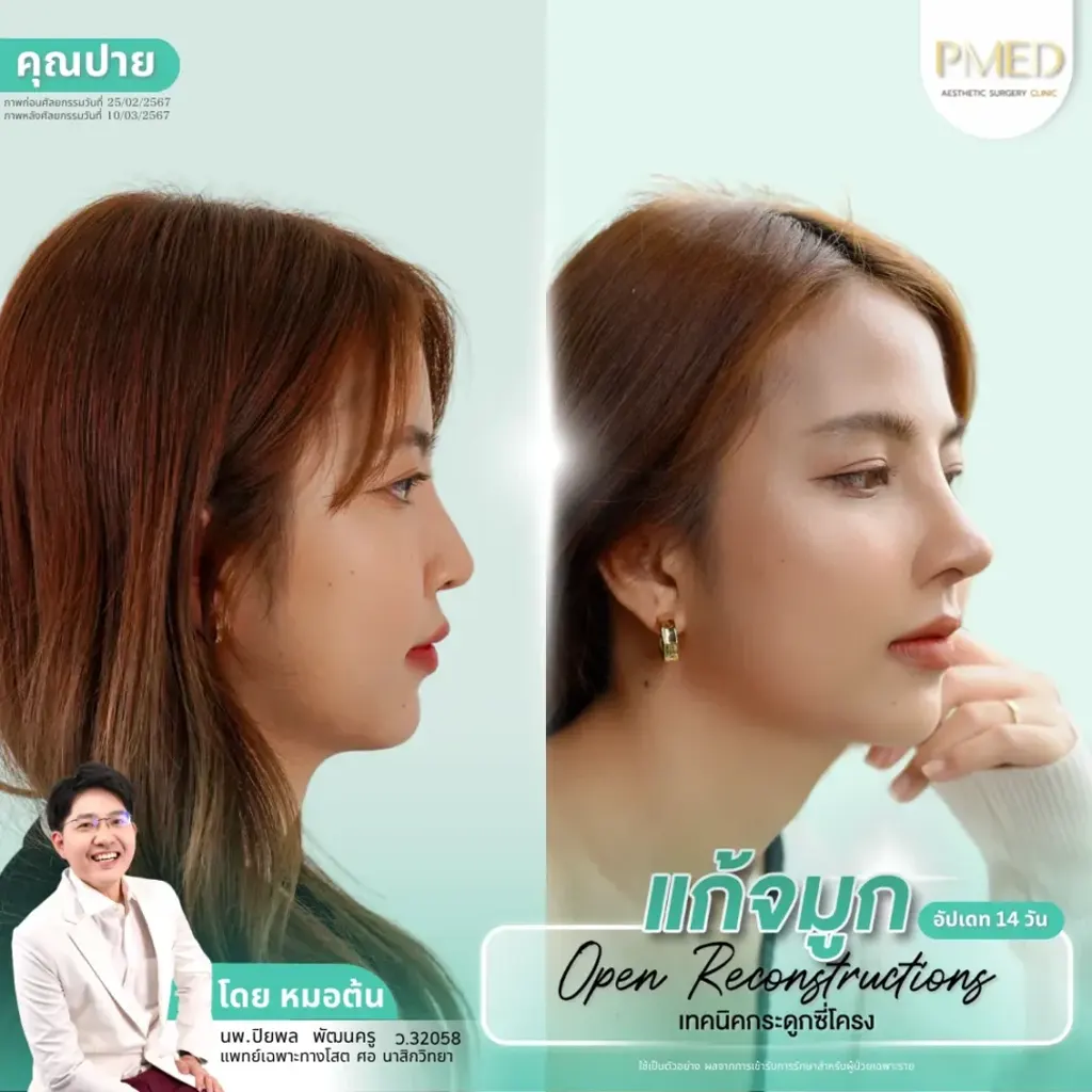 rib-cartilage-000027