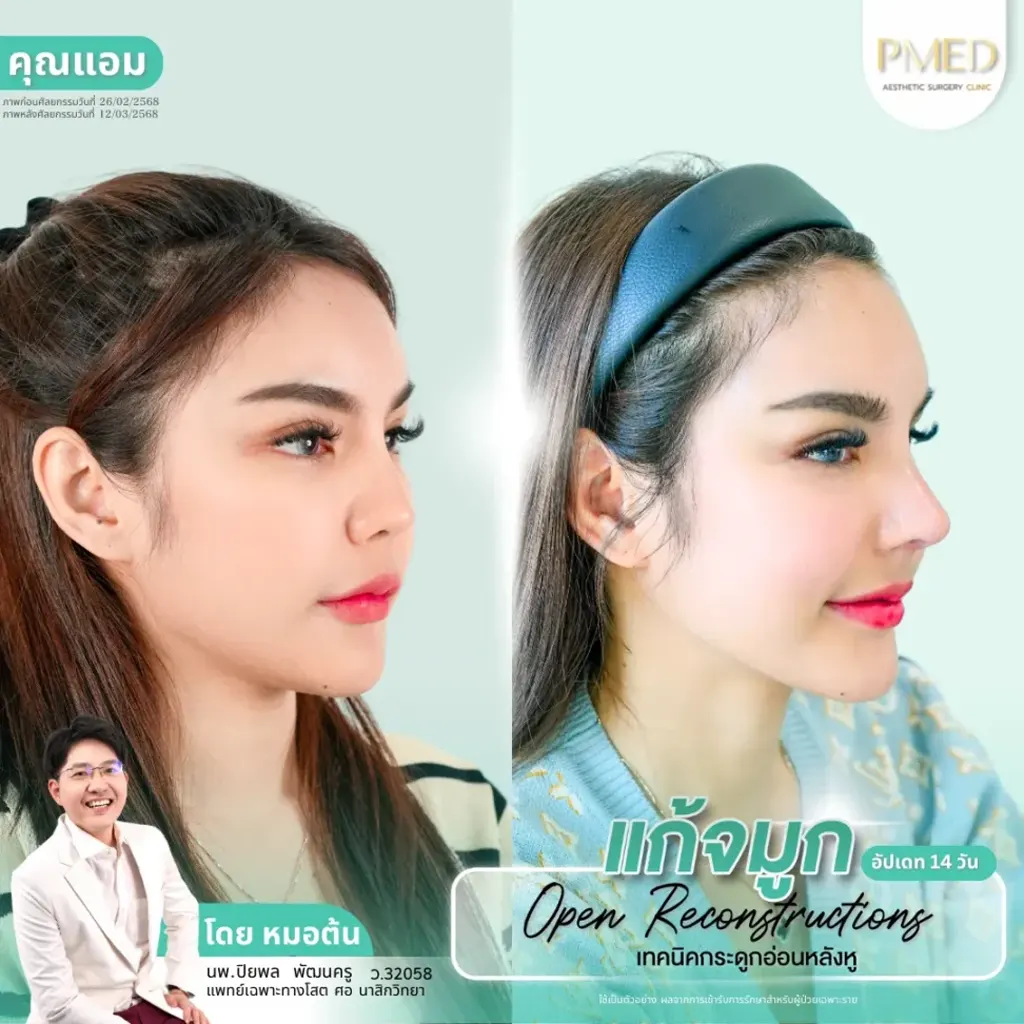 rib-cartilage-000028