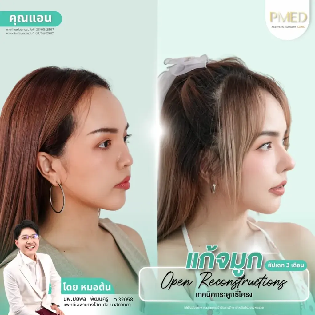 rib-cartilage-000029