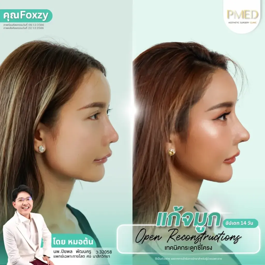 rib-cartilage-000031