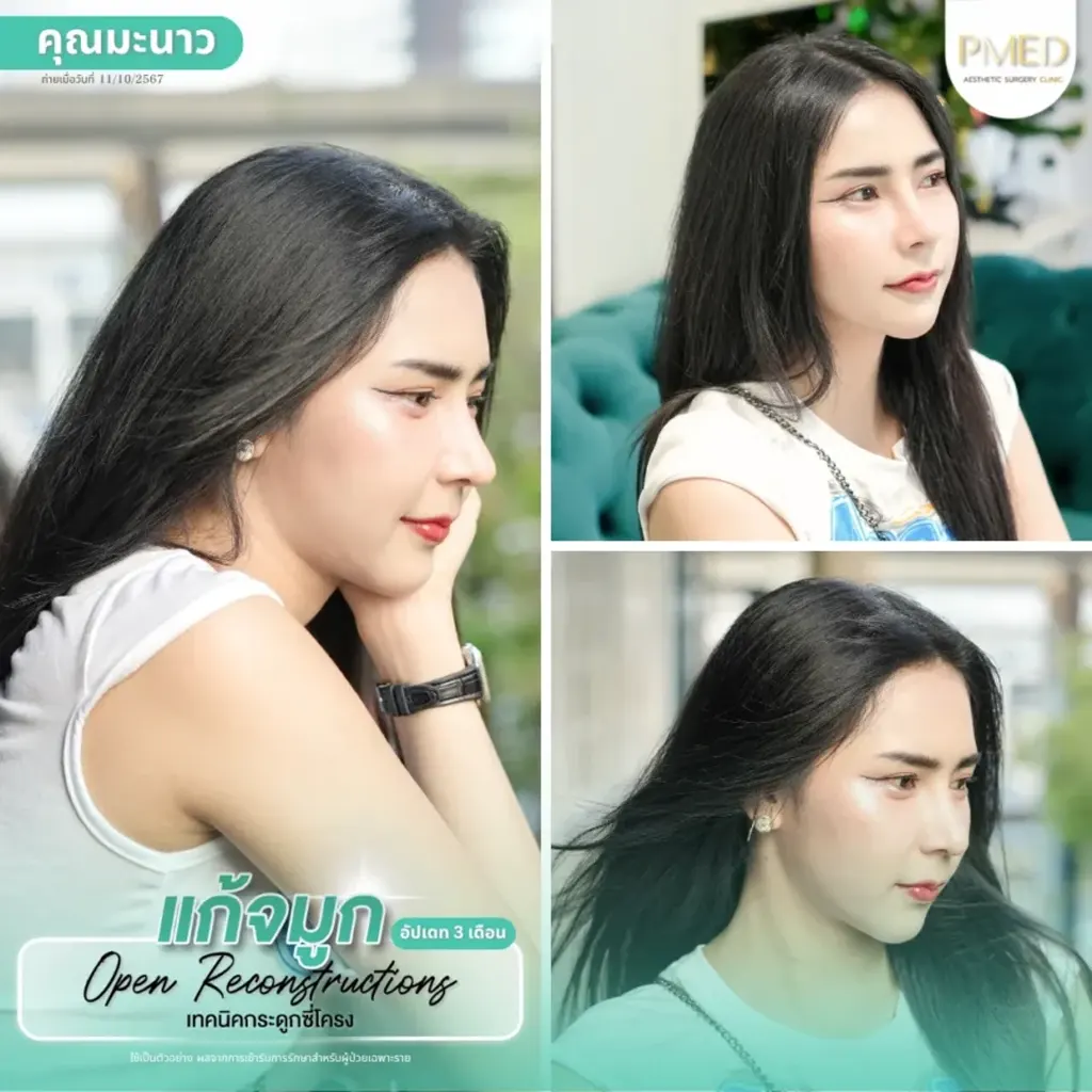 rib-cartilage-000033