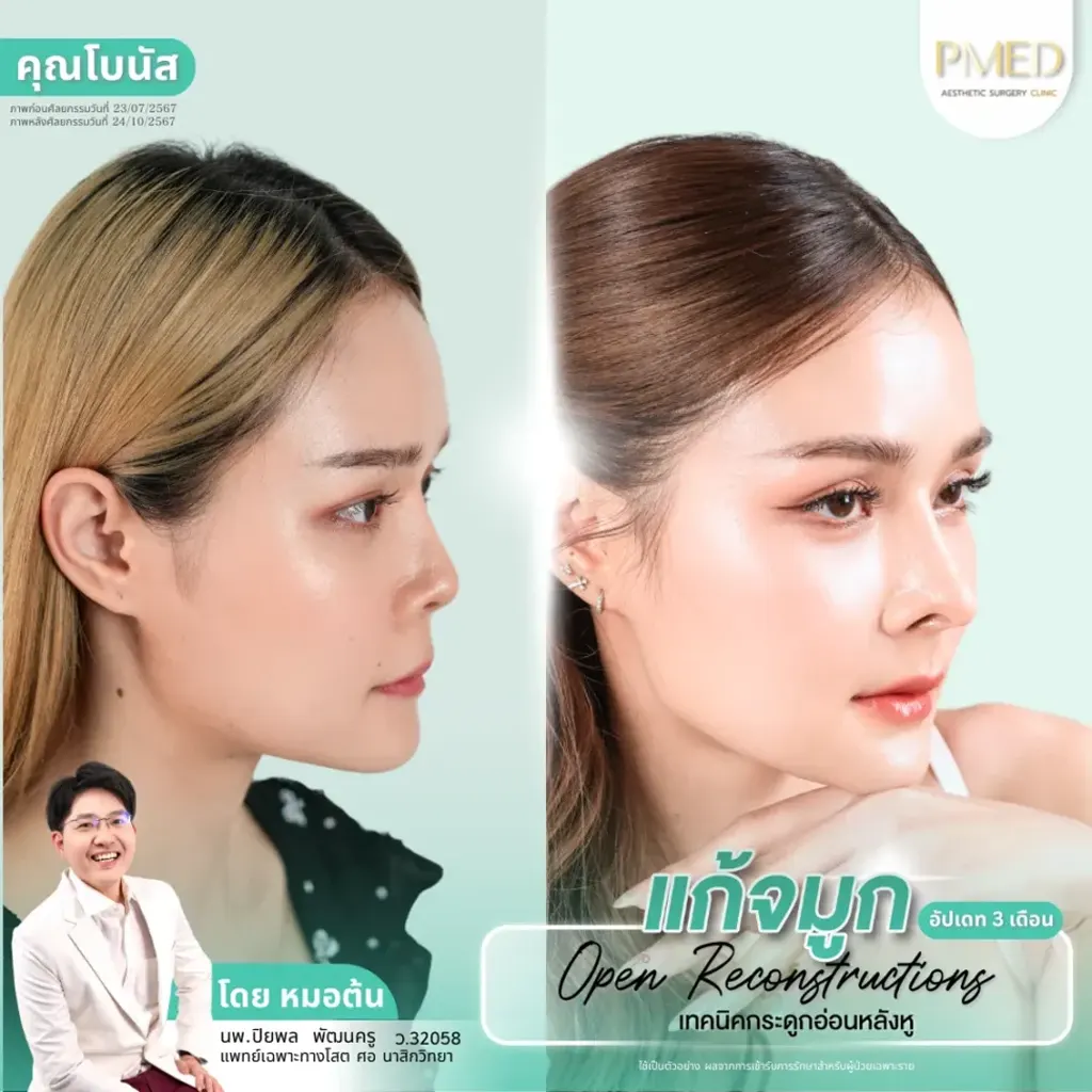 rib-cartilage-000034
