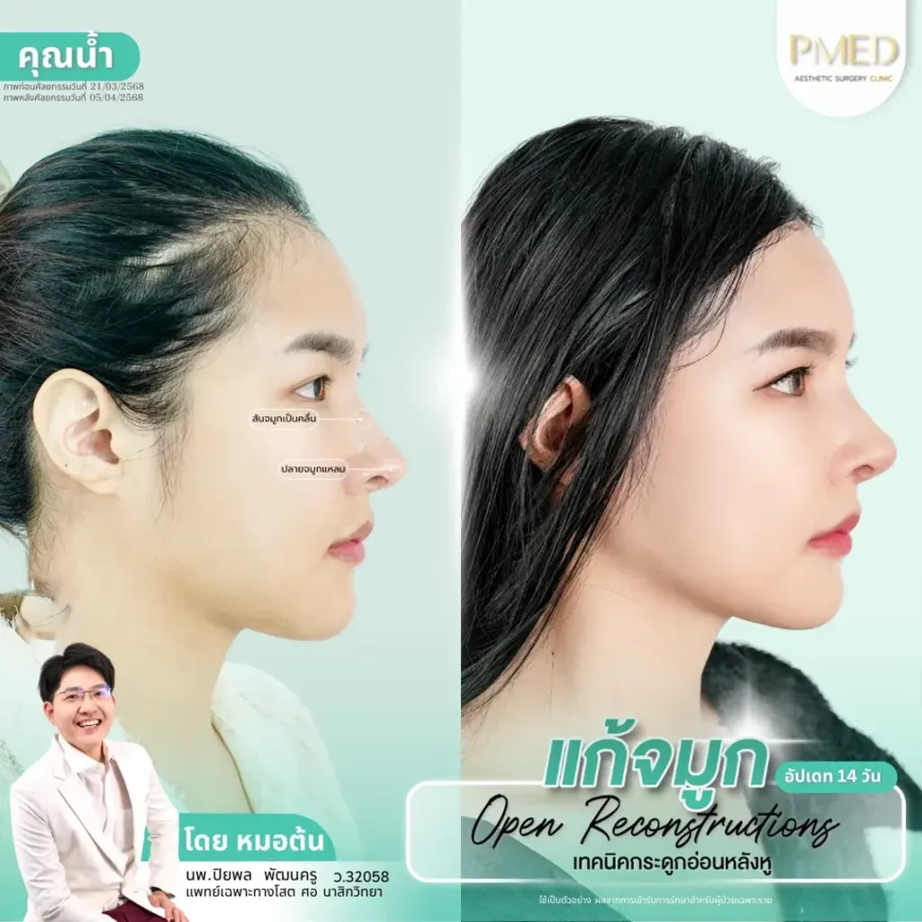 rib-cartilage-000041
