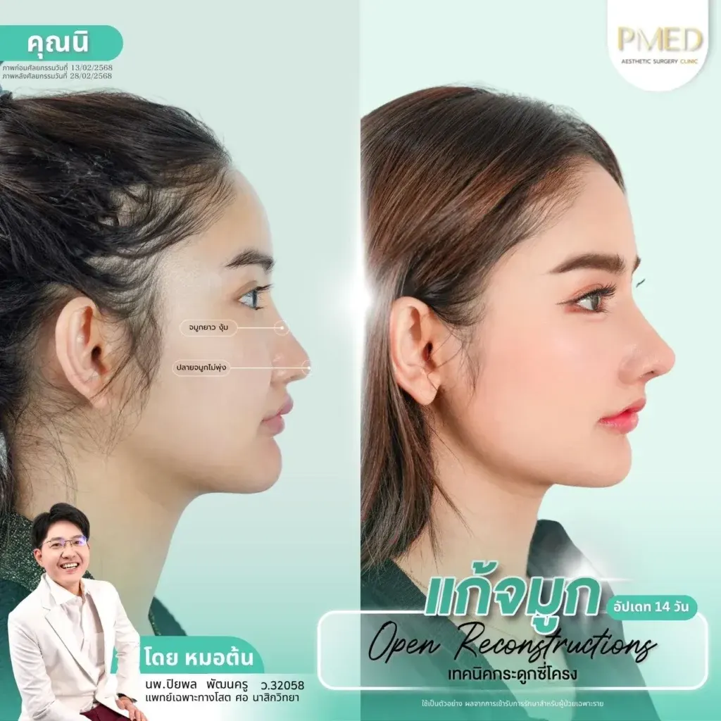 rib-cartilage-000043