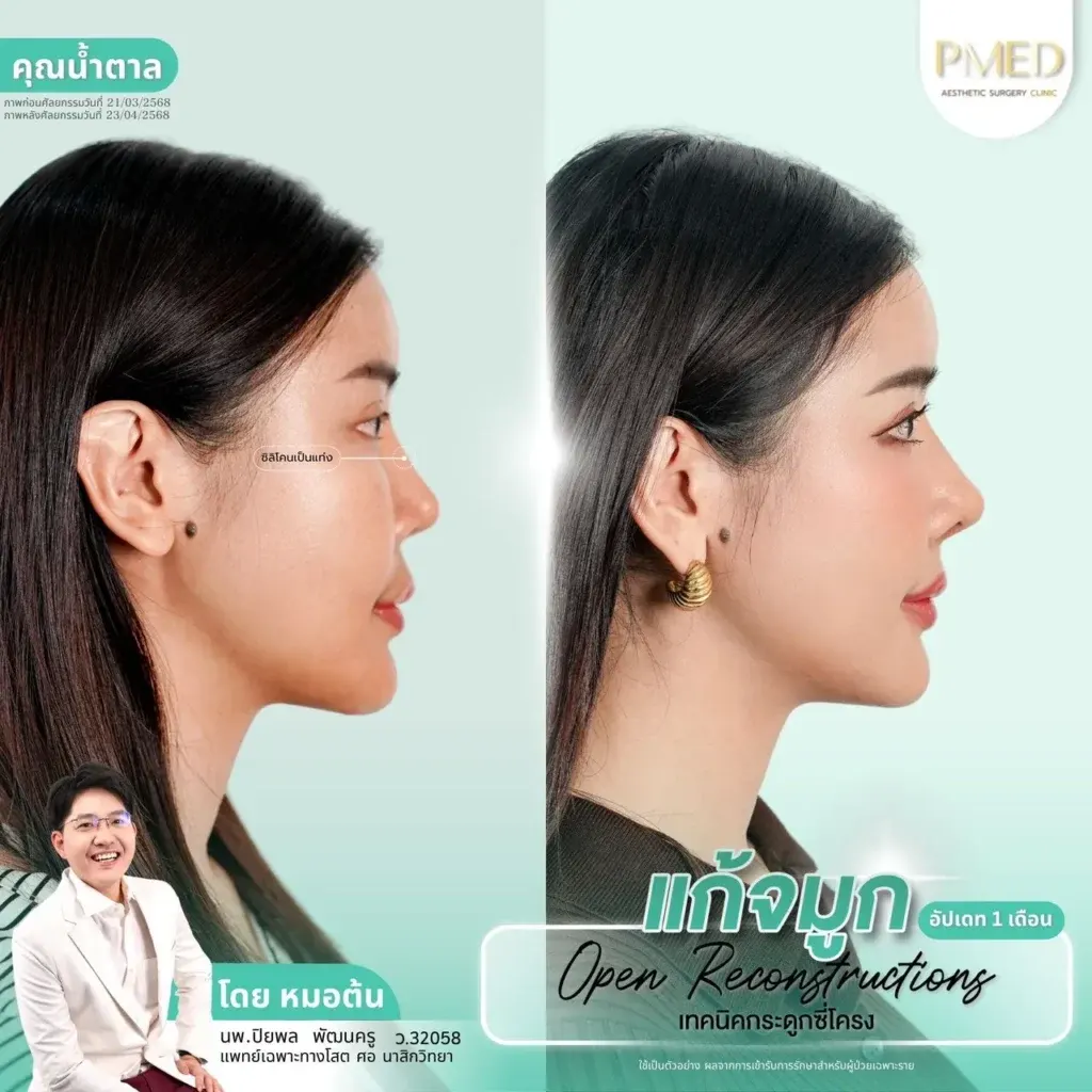 rib-cartilage-000045