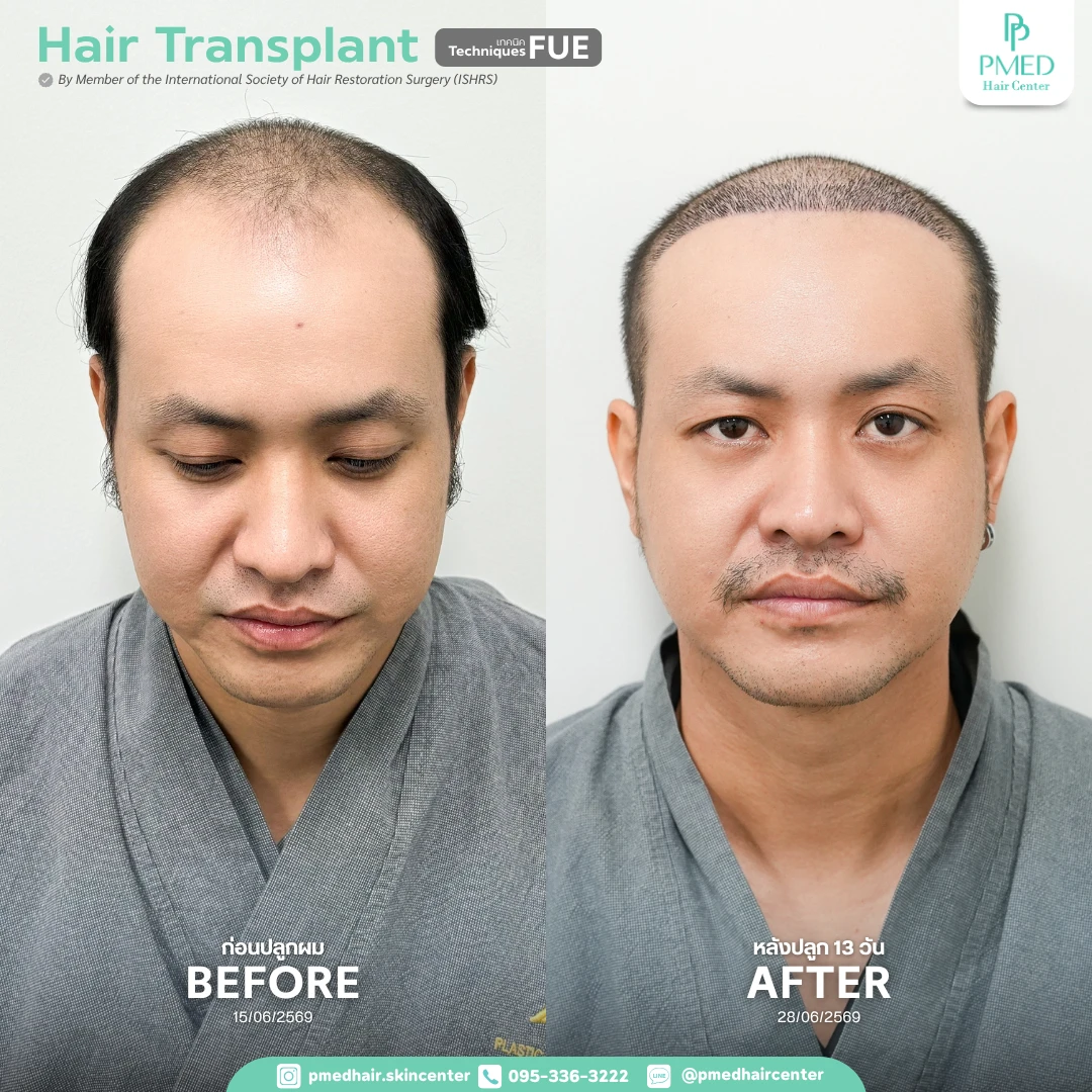 11 เปรียบเทียบเก็บประวัติ Pmed Hair Center (4)