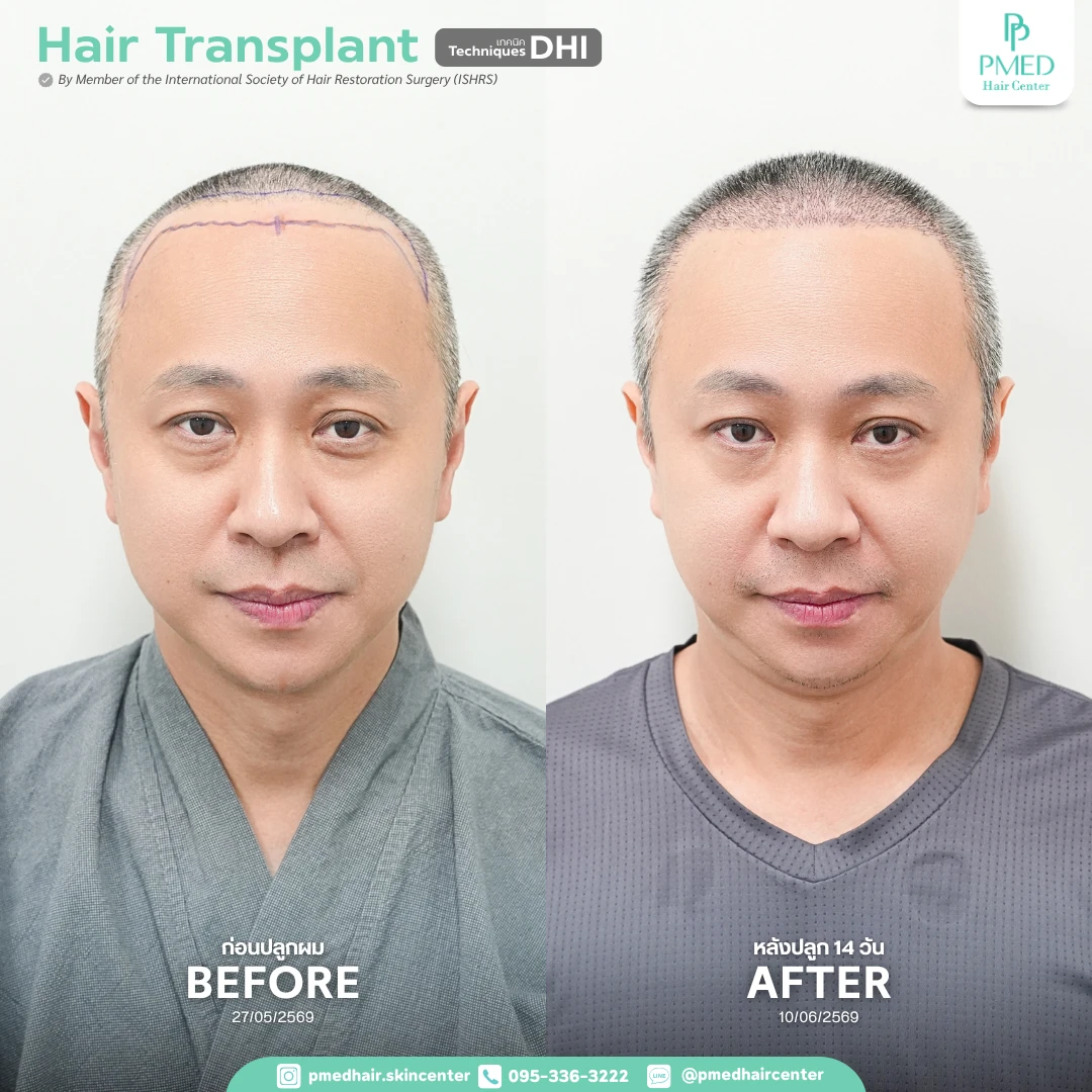 11 เปรียบเทียบเก็บประวัติ Pmed Hair Center (8)