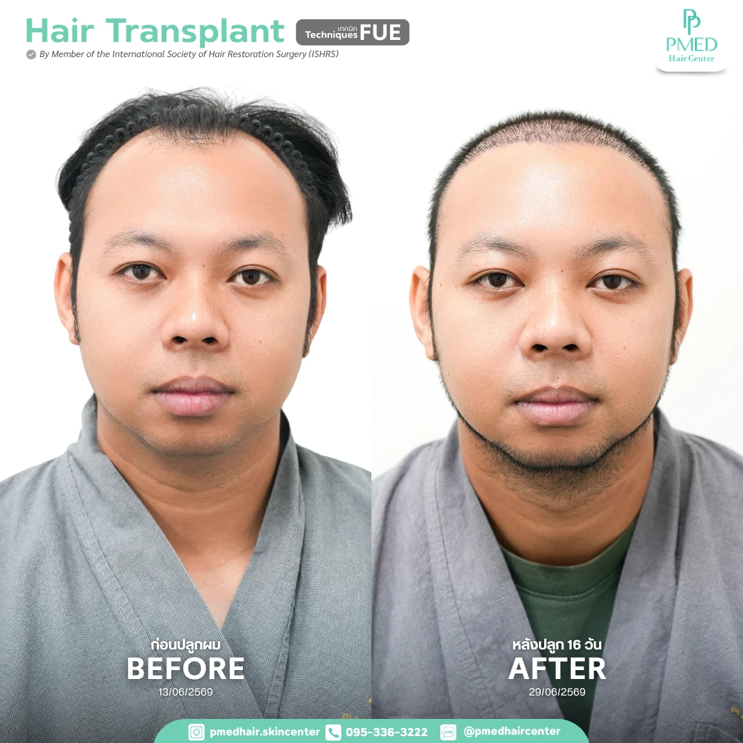 11 เปรียบเทียบเก็บประวัติ Pmed Hair Center