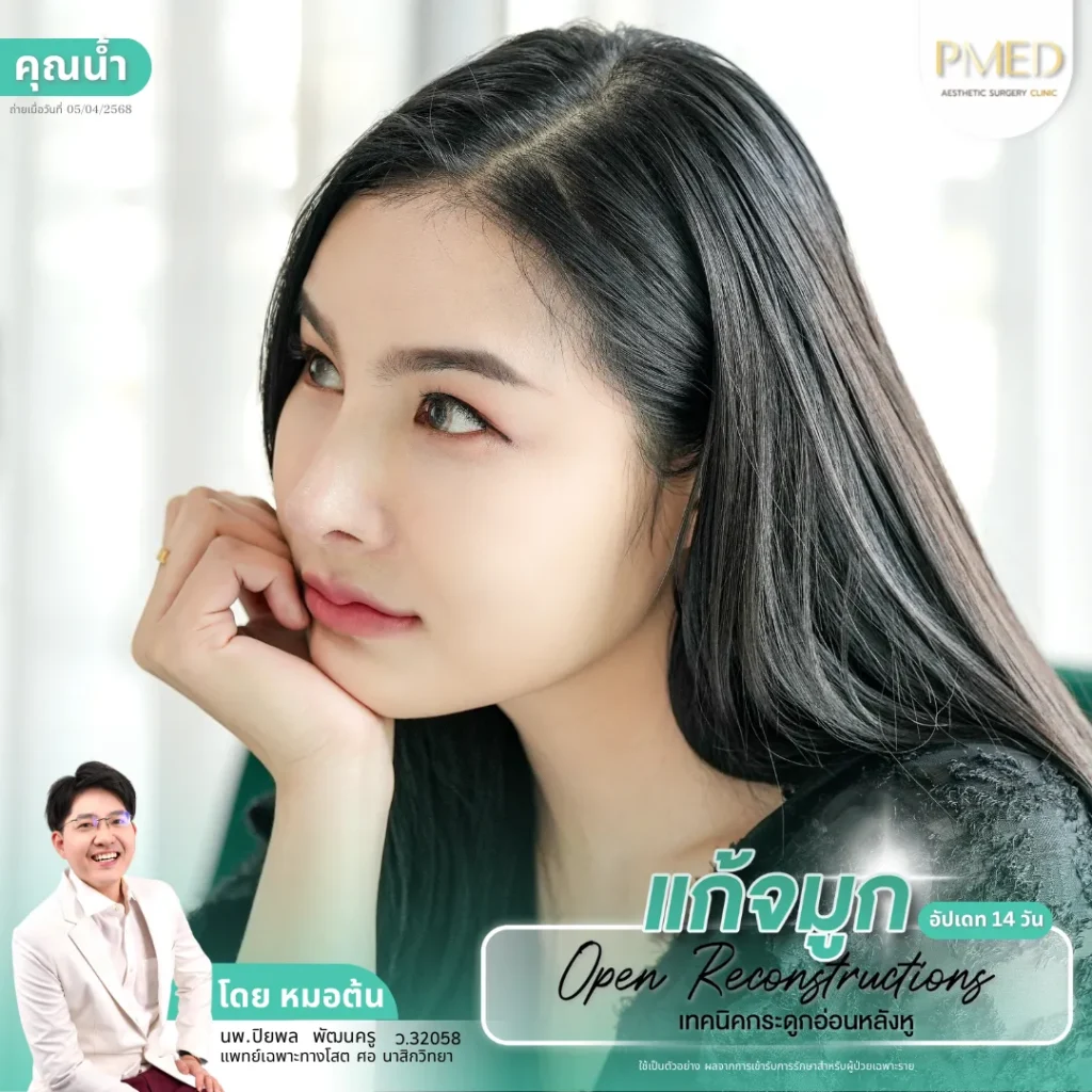 แก้จมูกคืออะไร? รู้ก่อนตัดสินใจ เพื่อผลลัพธ์ที่สวยและปลอดภัย