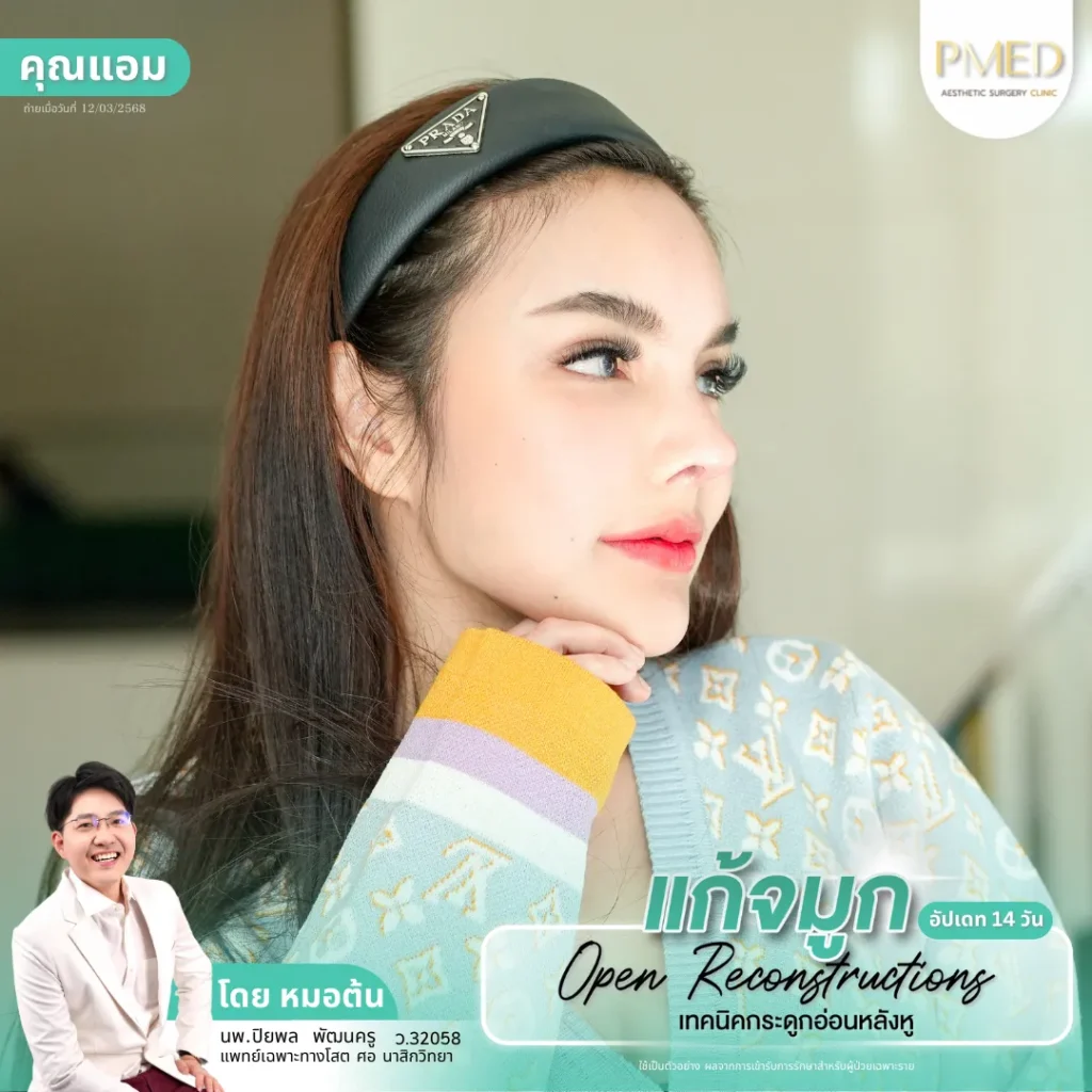 การเสริมจมูกด้วยกระดูกอ่อนหลังหูคืออะไร? เทคนิคยอดนิยม ลดความเสี่ยงจมูกทะลุ