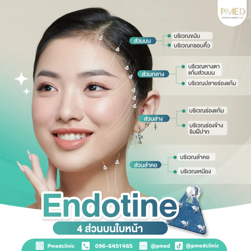 Endotine คืออะไร? ยกกระชับใบหน้าอย่างเป็นธรรมชาติด้วยเทคนิคศัลยกรรมสมัยใหม่