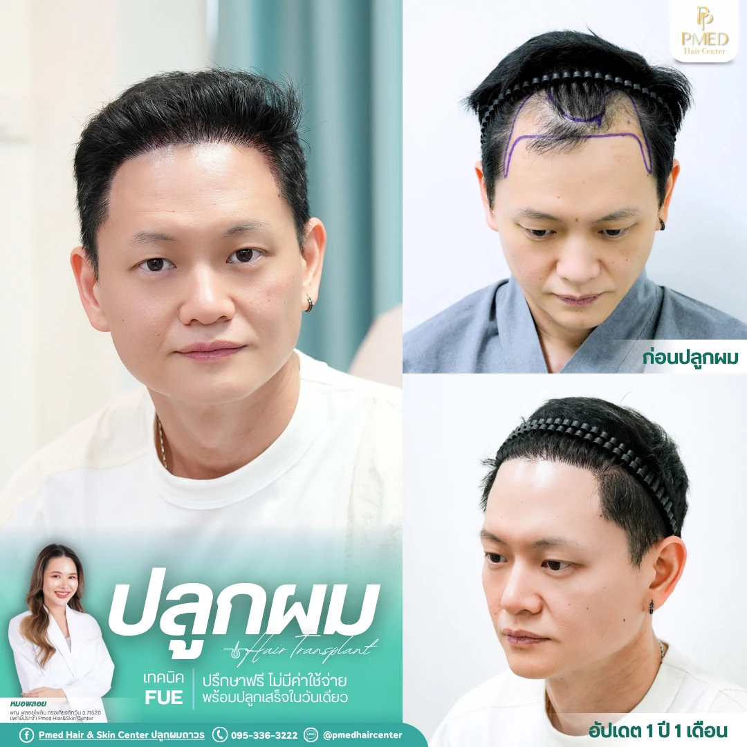 (Grid3) รีวิวปลูกผมpmed&42G (42)