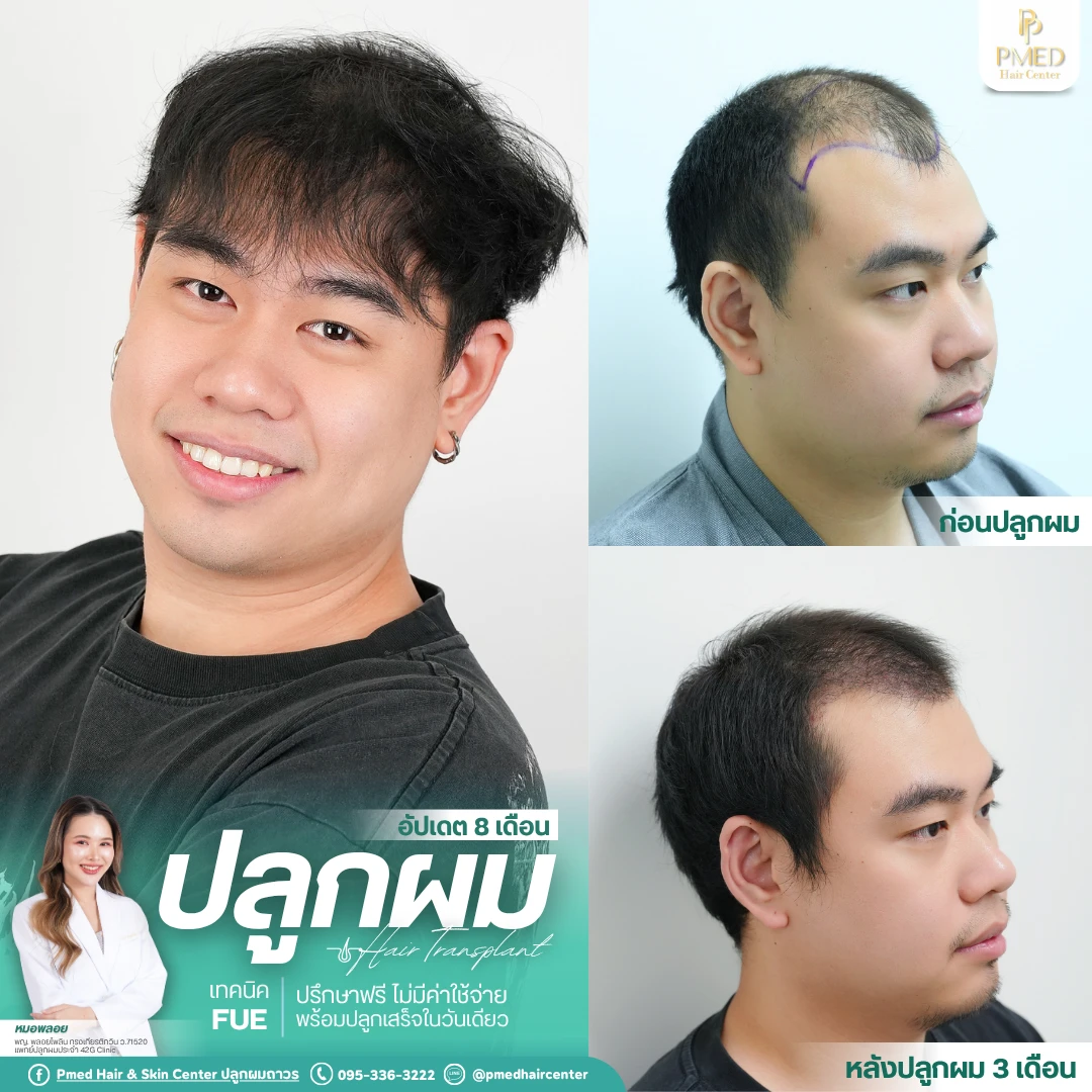 (Grid3) รีวิวปลูกผมpmed&42G (43)