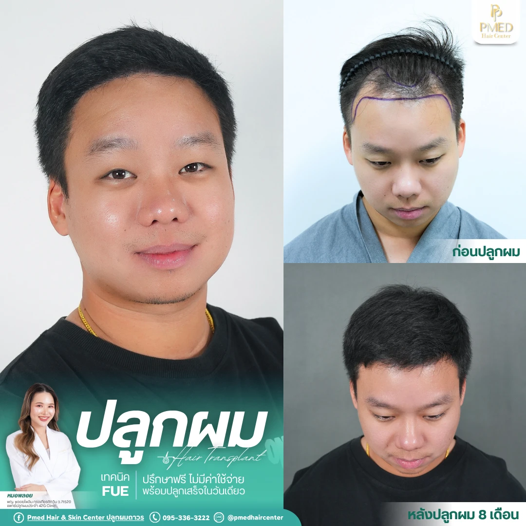 (Grid3) รีวิวปลูกผมpmed&42G (44)