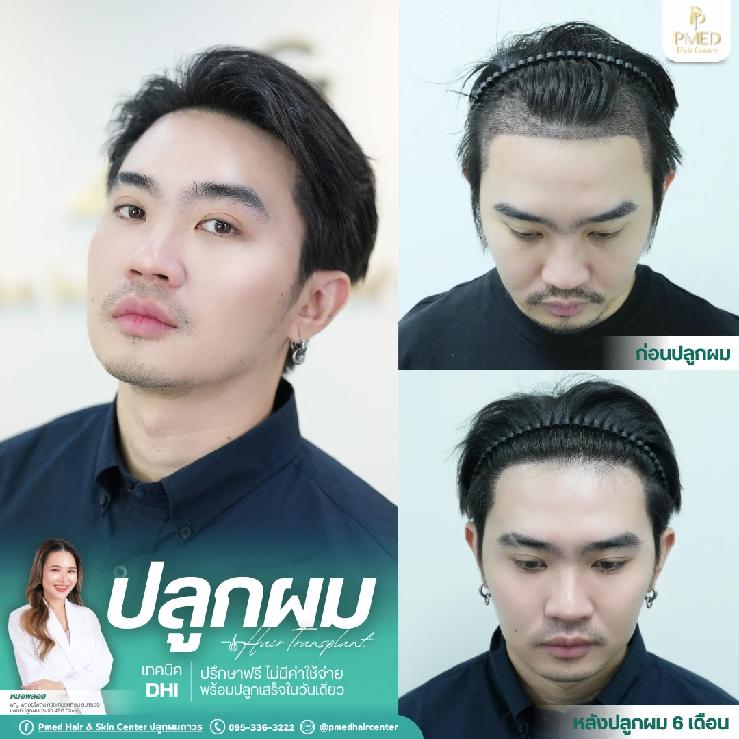 (Grid3) รีวิวปลูกผมpmed&42G (45)