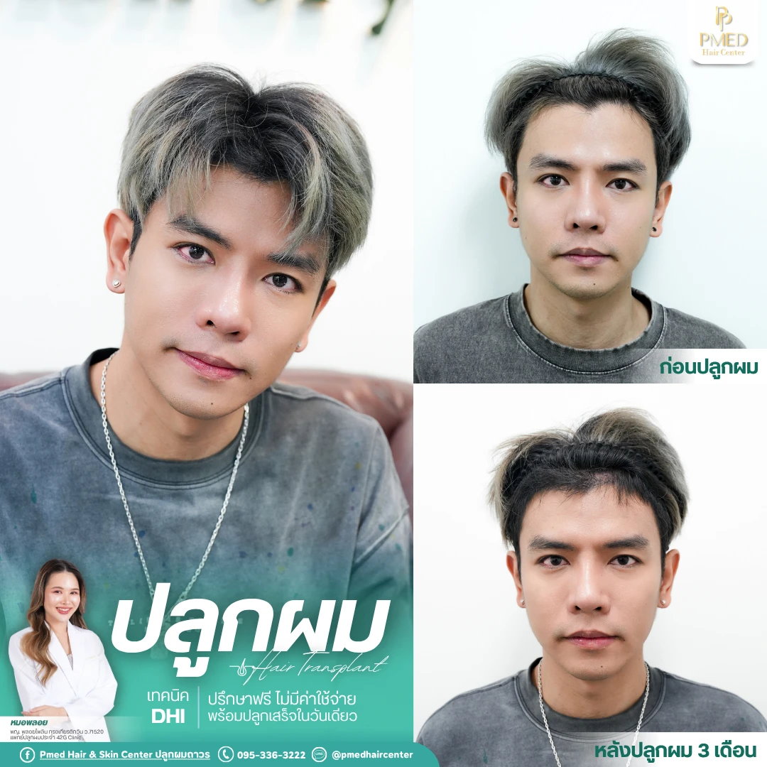 (Grid3) รีวิวปลูกผมpmed&42G (46)