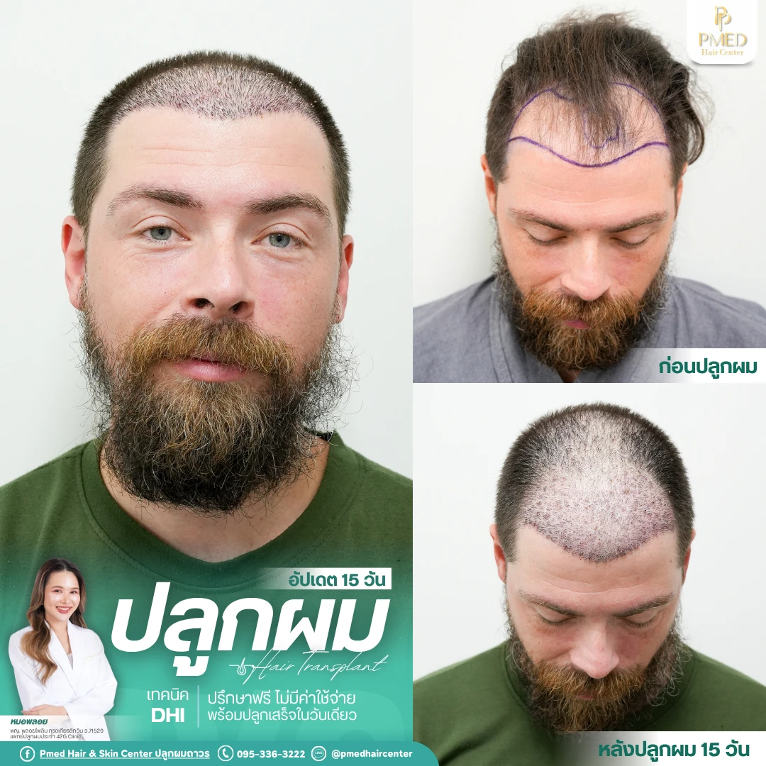 (Grid3) รีวิวปลูกผมpmed&42G (47)