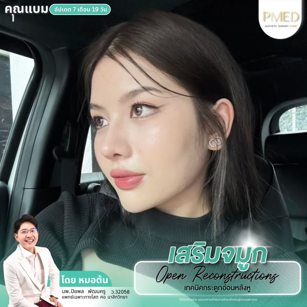 LINE_ALBUM_จมูก 👂🏻 เทคนิคกระดูกอ่อนหลังหู_260715_11