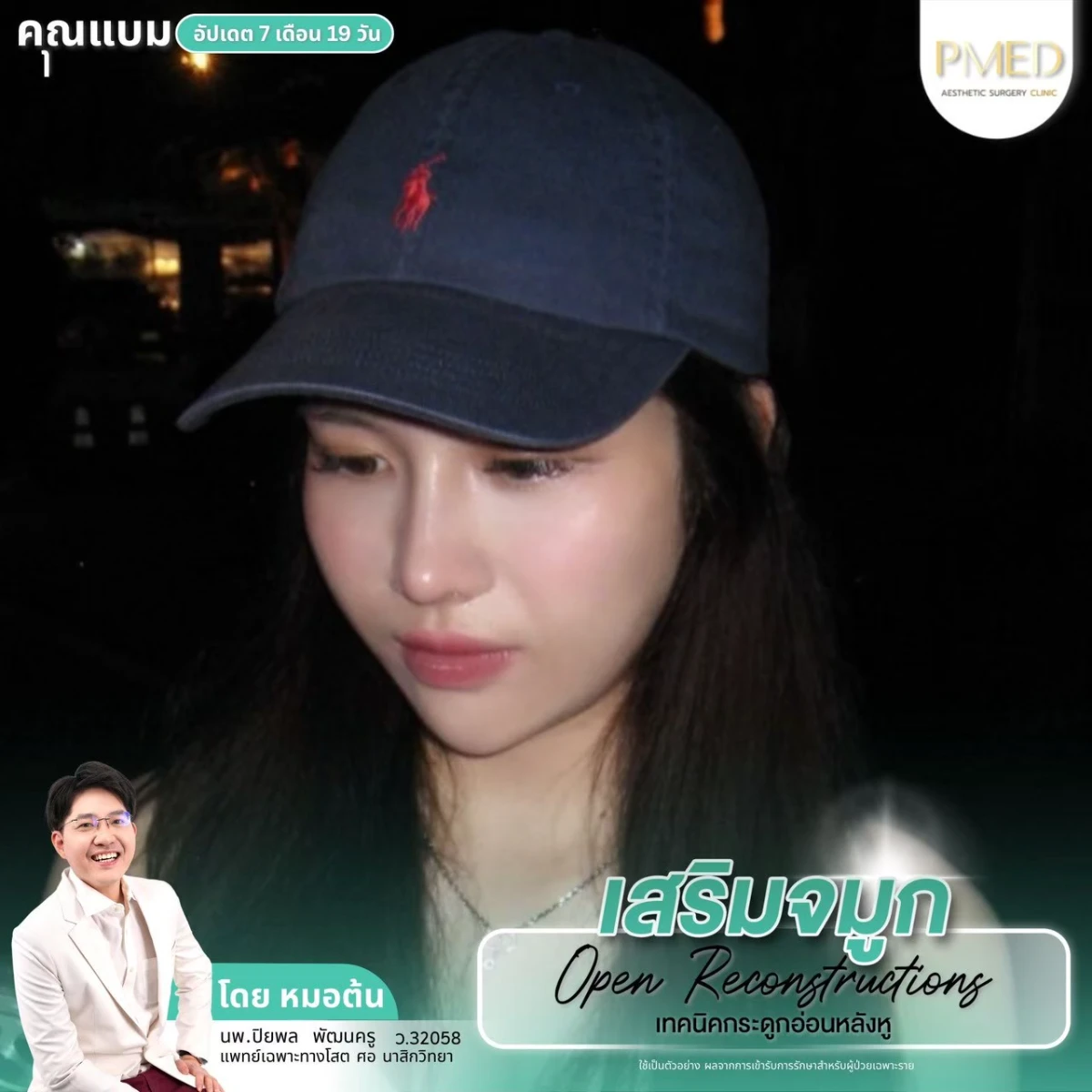 LINE_ALBUM_จมูก 👂🏻 เทคนิคกระดูกอ่อนหลังหู_260715_14