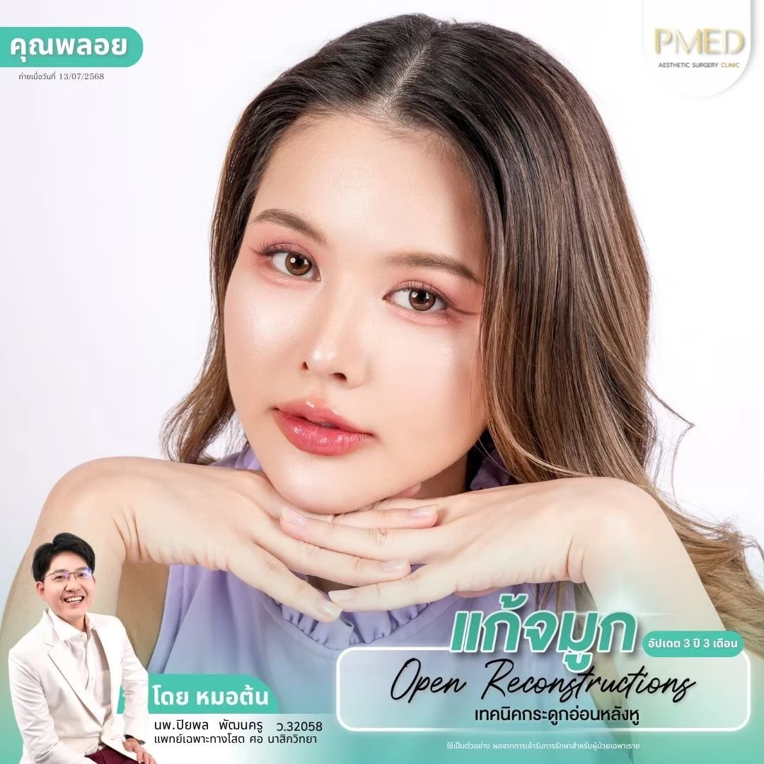 LINE_ALBUM_จมูก 👂🏻 เทคนิคกระดูกอ่อนหลังหู_260715_70