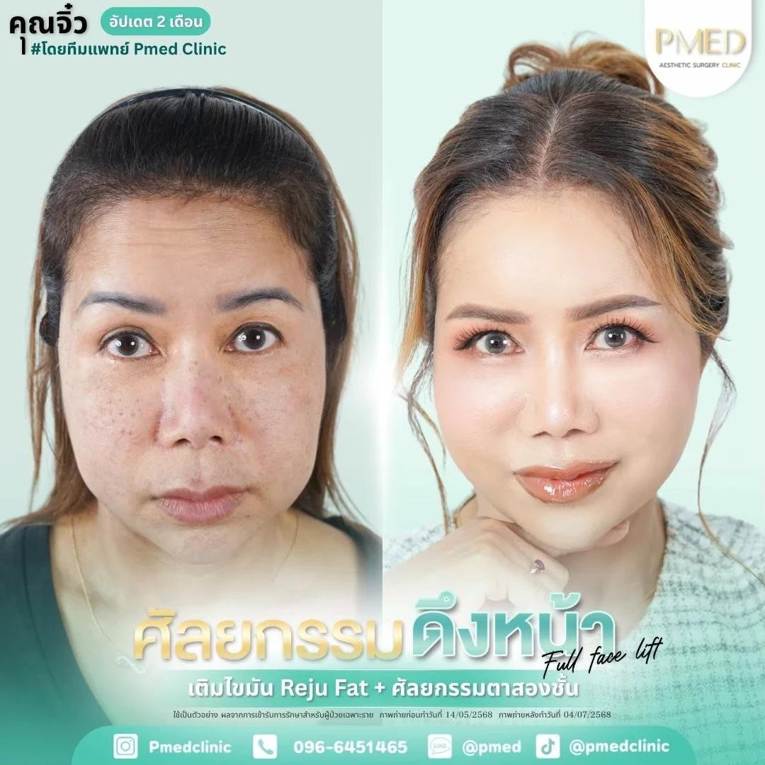 LINE_ALBUM_ดึงหน้า Full Face Lift_260718_10