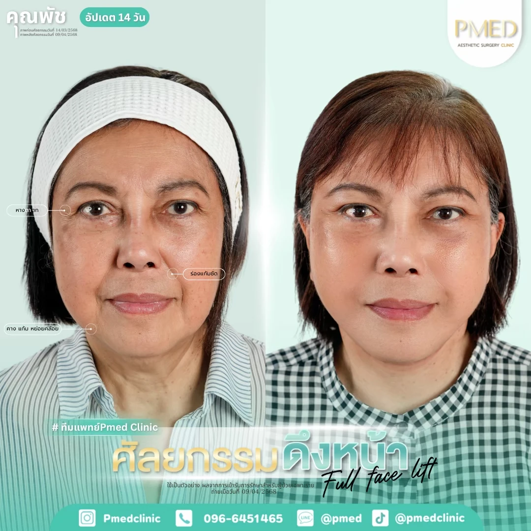 LINE_ALBUM_ดึงหน้า Full Face Lift_260718_14