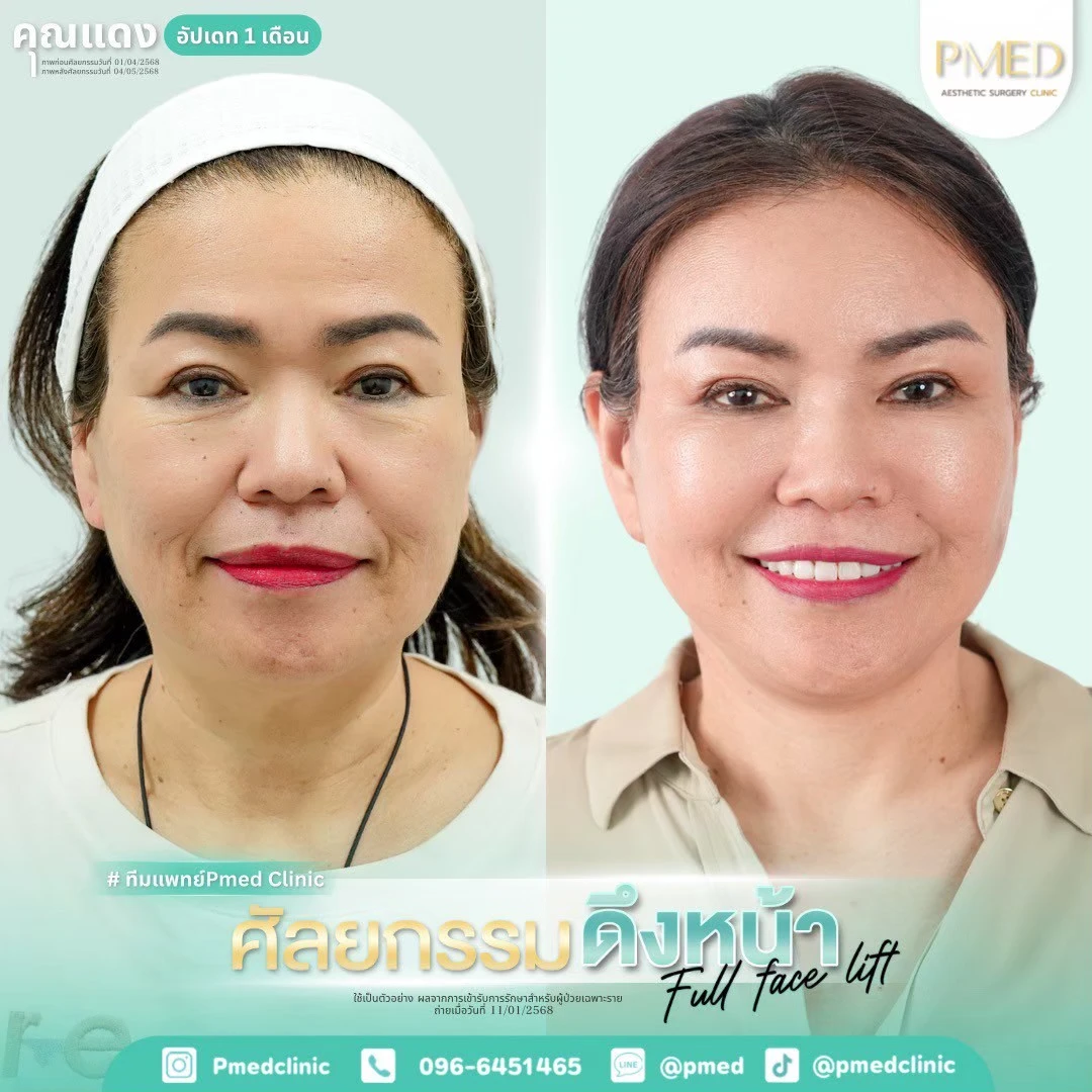 LINE_ALBUM_ดึงหน้า Full Face Lift_260718_17