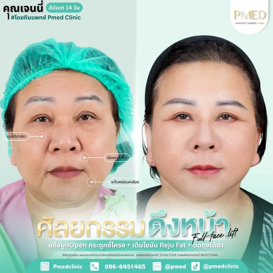 LINE_ALBUM_ดึงหน้า Full Face Lift_260718_2