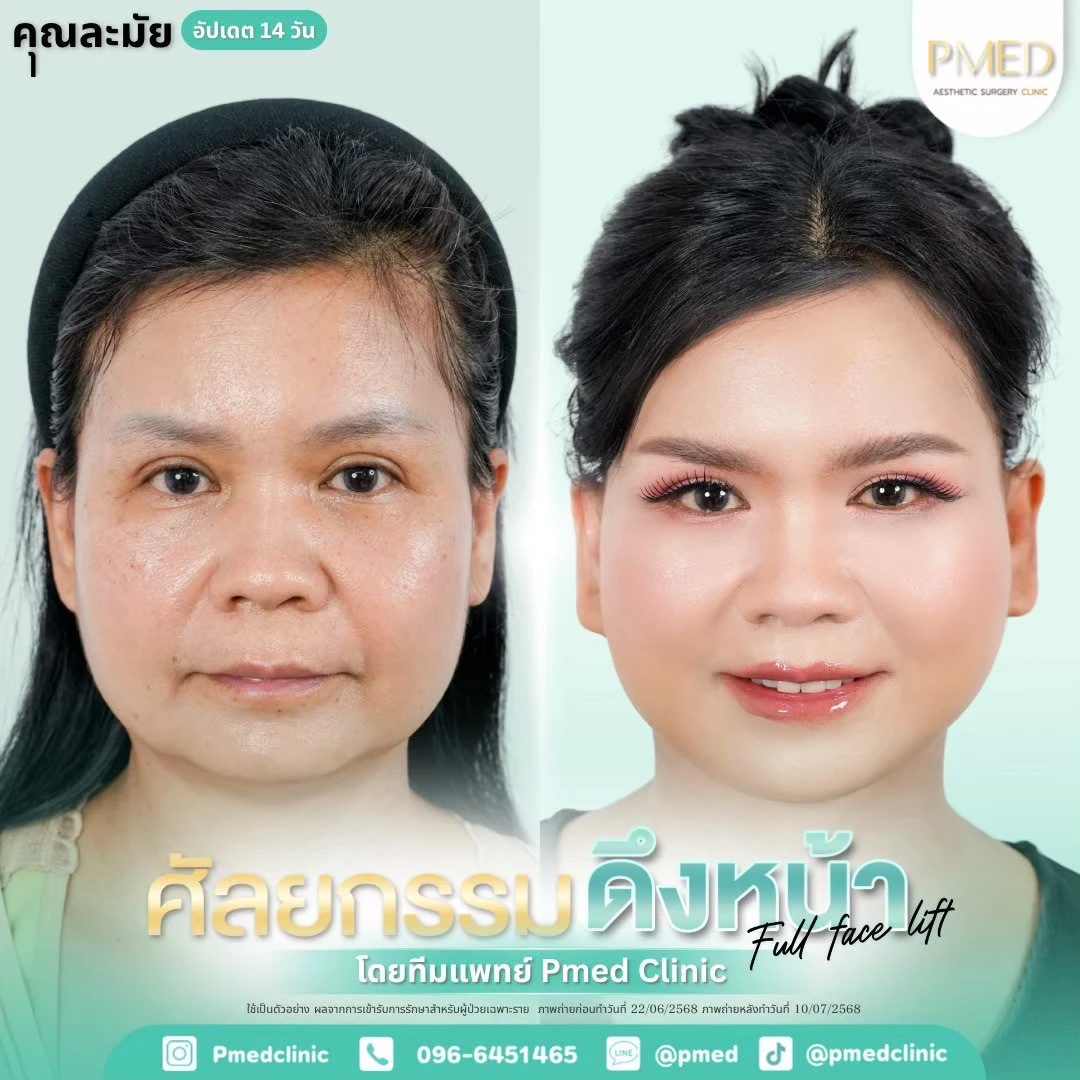 LINE_ALBUM_ดึงหน้า Full Face Lift_260718_3