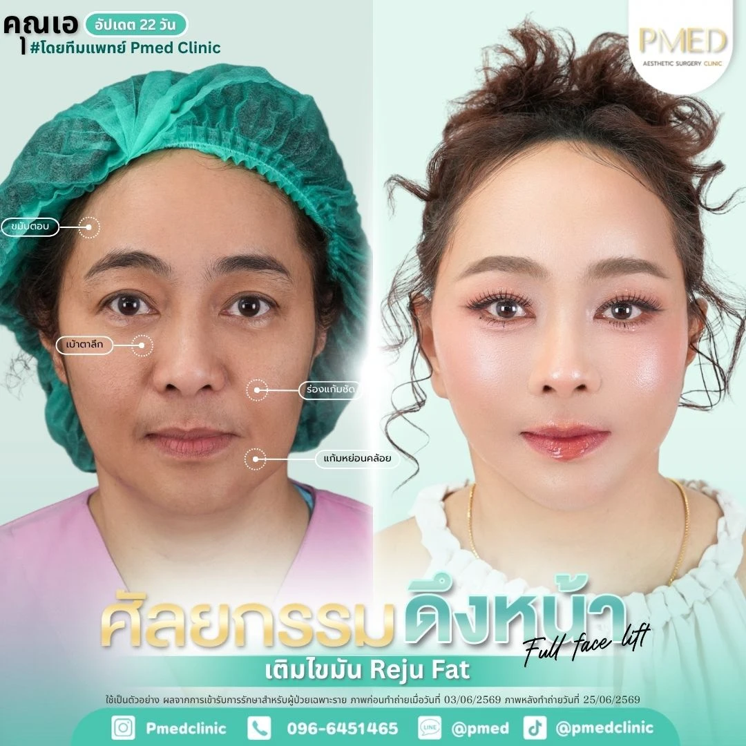 LINE_ALBUM_ดึงหน้า Full Face Lift_260718_56