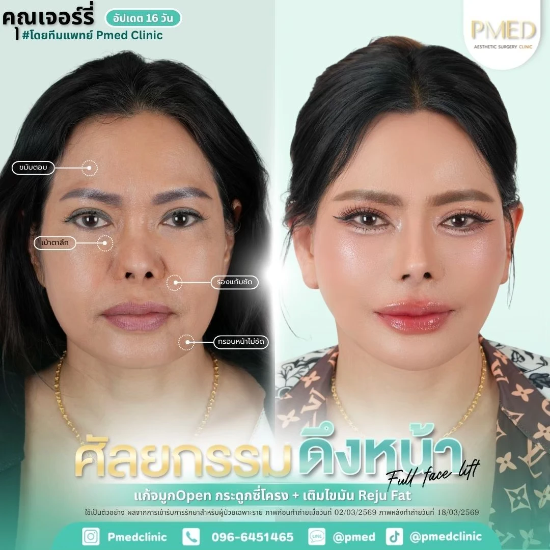 LINE_ALBUM_ดึงหน้า Full Face Lift_260718_62