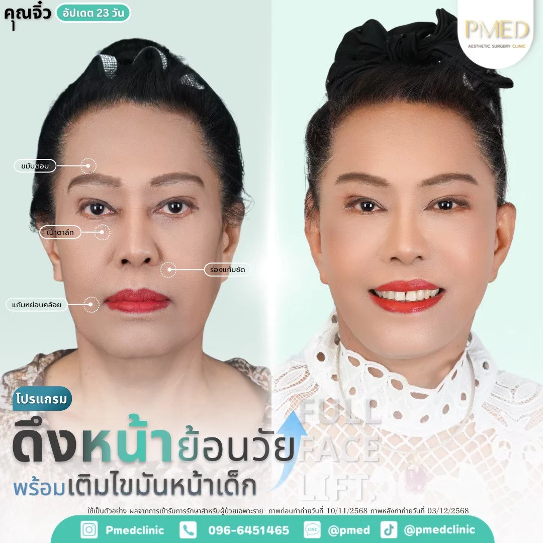 LINE_ALBUM_ดึงหน้า Full Face Lift_260718_64