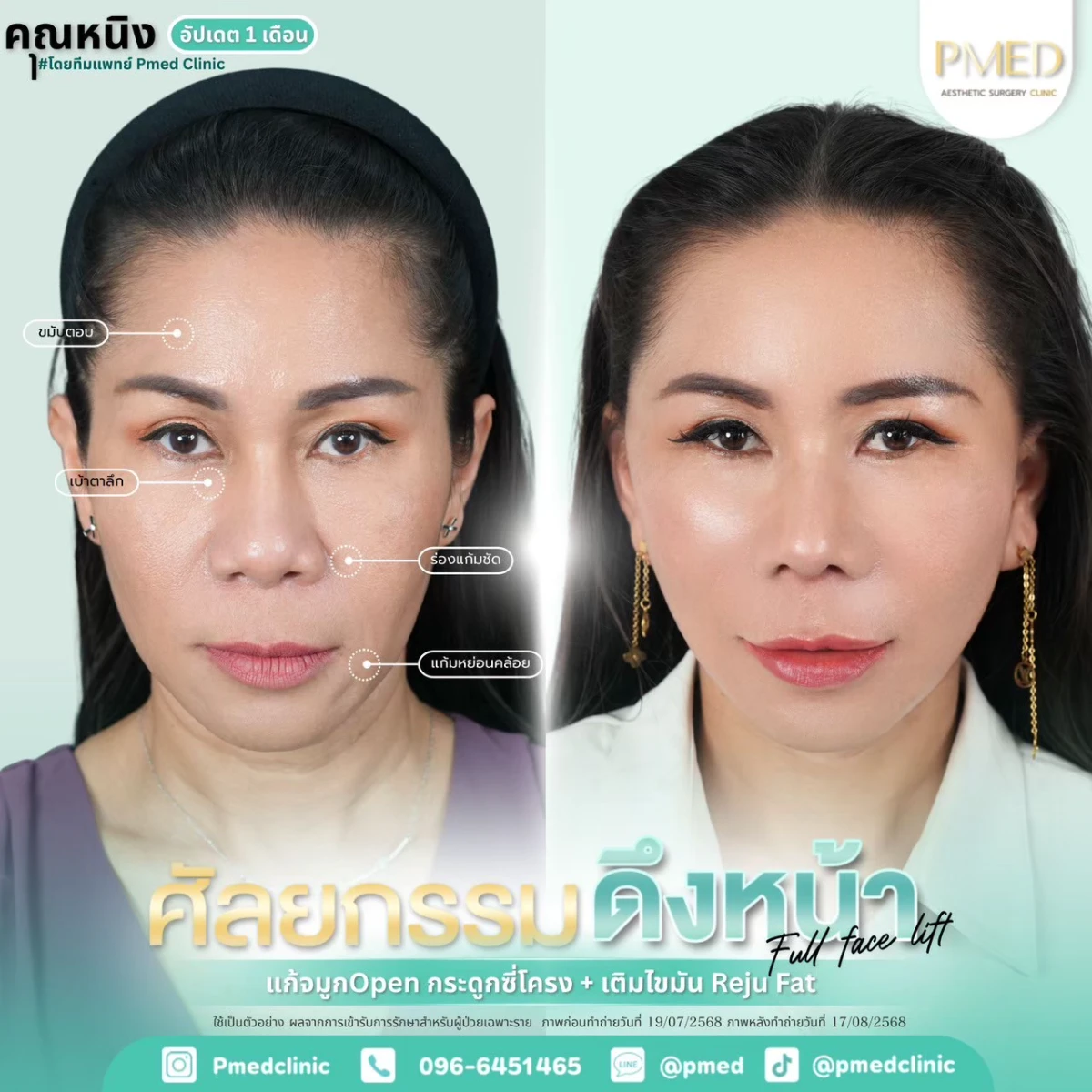 LINE_ALBUM_ดึงหน้า Full Face Lift_260718_74