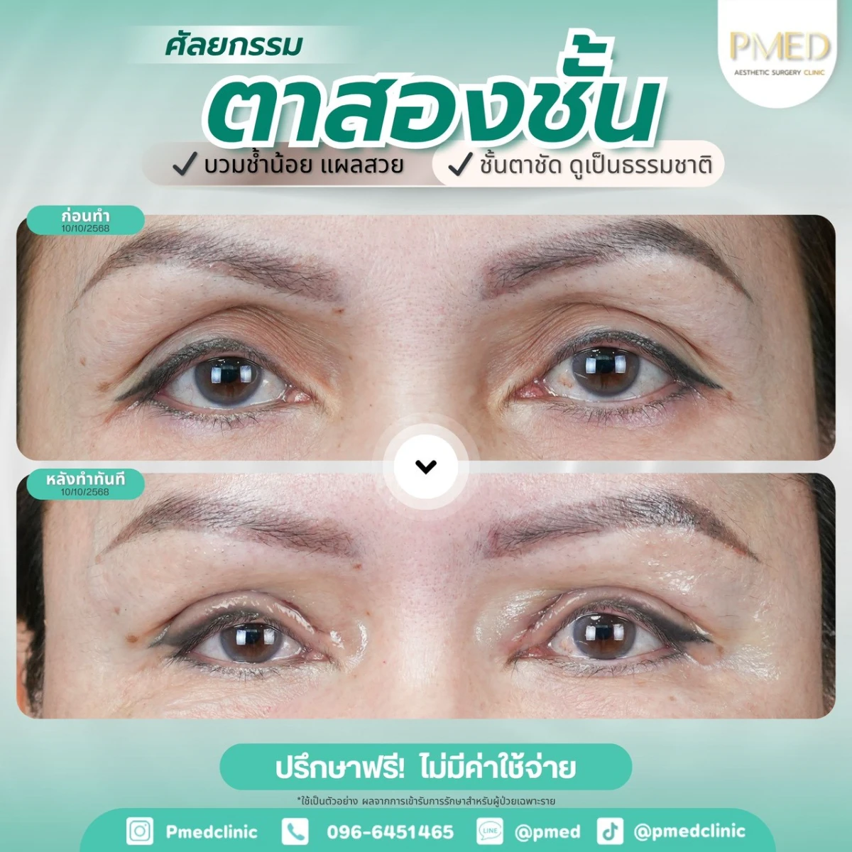 LINE_ALBUM_ตาสองชั้น 👁️_260715_1