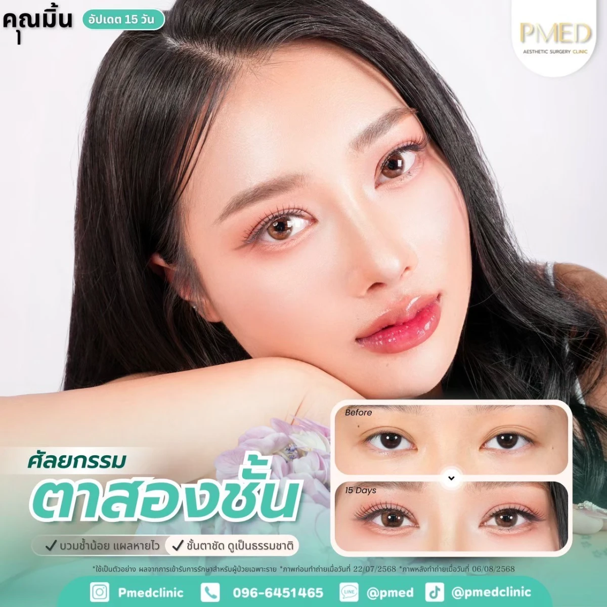 LINE_ALBUM_ตาสองชั้น 👁️_260715_10