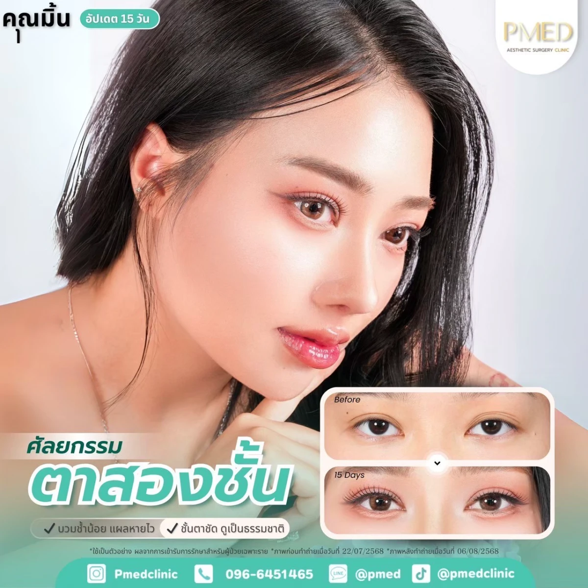 LINE_ALBUM_ตาสองชั้น 👁️_260715_11