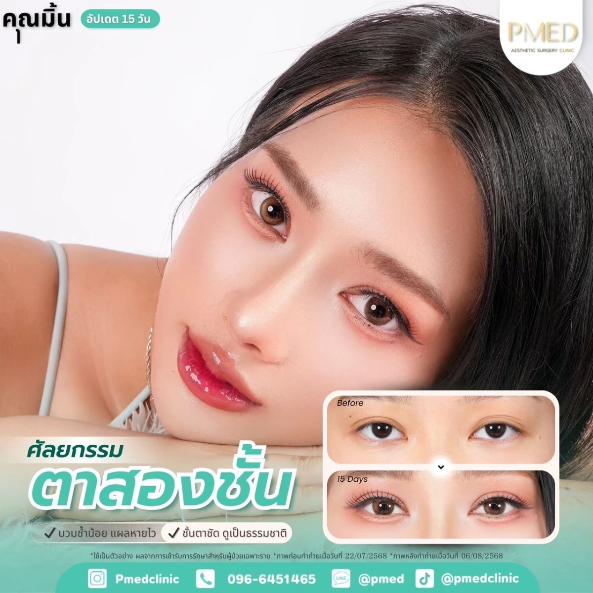 LINE_ALBUM_ตาสองชั้น 👁️_260715_12