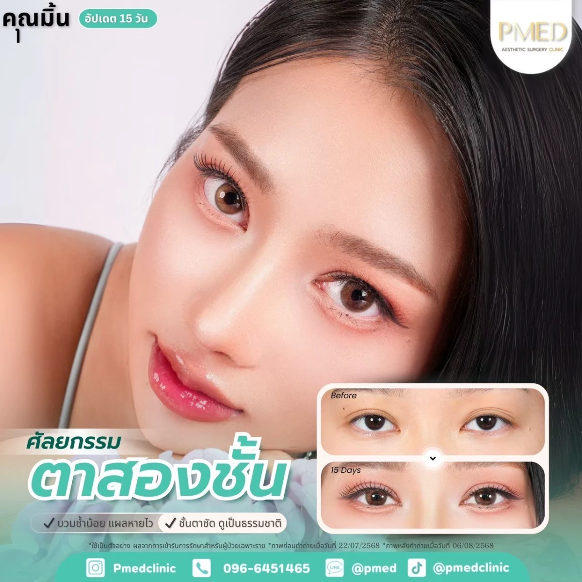 LINE_ALBUM_ตาสองชั้น 👁️_260715_13