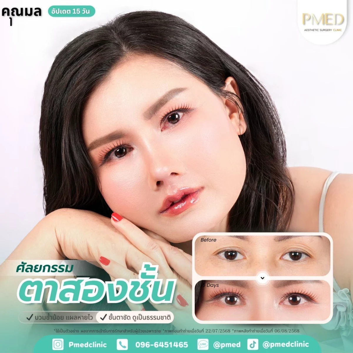 LINE_ALBUM_ตาสองชั้น 👁️_260715_14