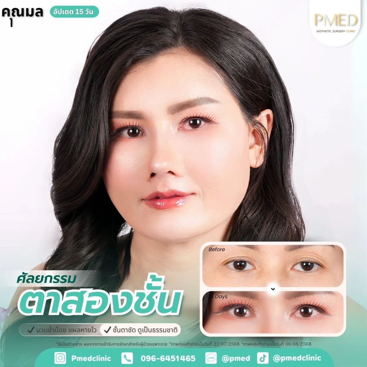 LINE_ALBUM_ตาสองชั้น 👁️_260715_15