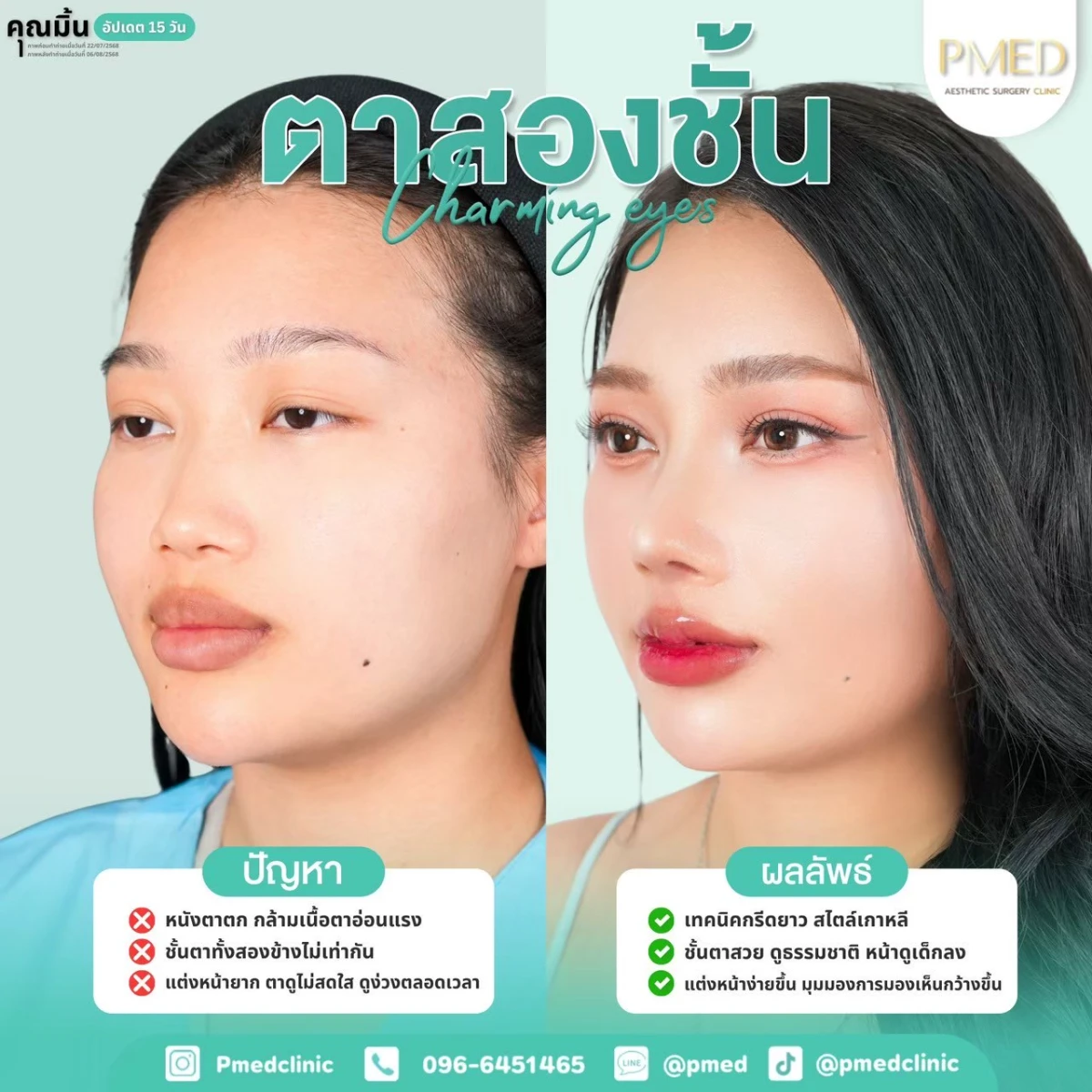 LINE_ALBUM_ตาสองชั้น 👁️_260715_17