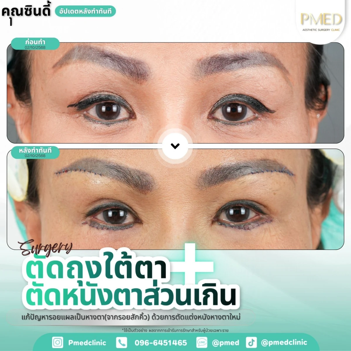 LINE_ALBUM_ตาสองชั้น 👁️_260715_2